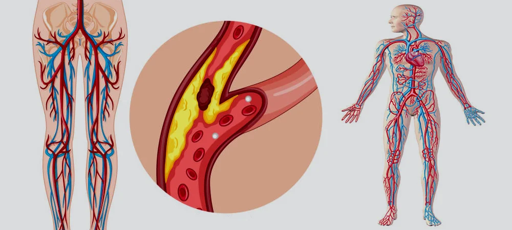 Vascular Diseases